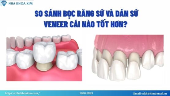 So Sánh Bọc Răng Sứ Và Dán Sứ Veneer Chi Tiết Nhất